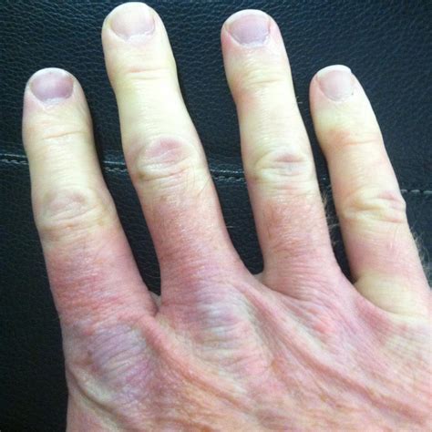 Raynauds disease